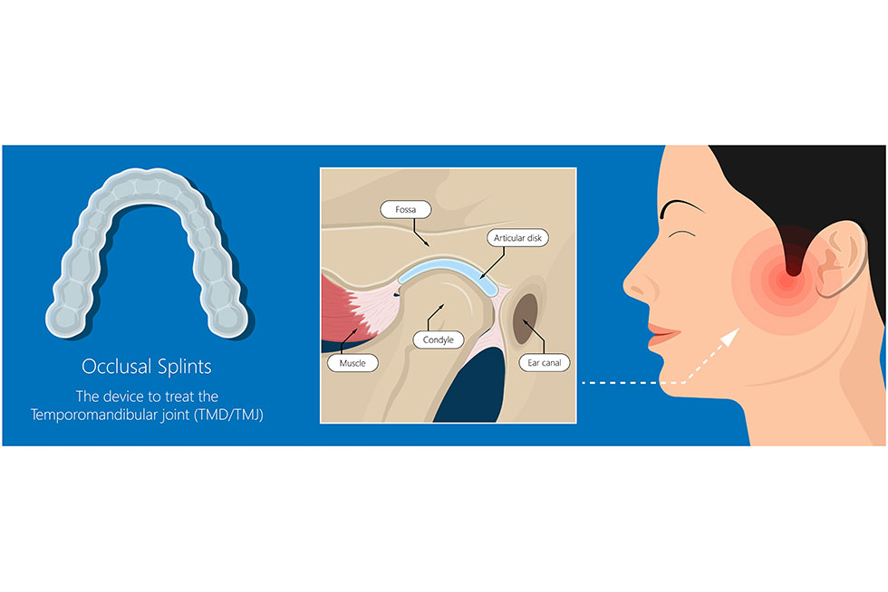 What You Need To Know About TMJ Appliances